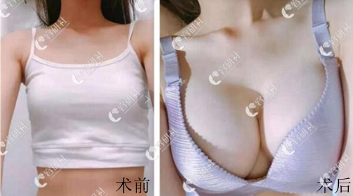 韩国LARED莱虹整形外科.皮肤科隆胸案例