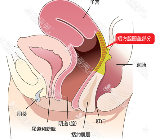 后方膣圆盖术手术部位示意图