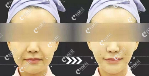韩国明星线整形外科拉皮手术案例