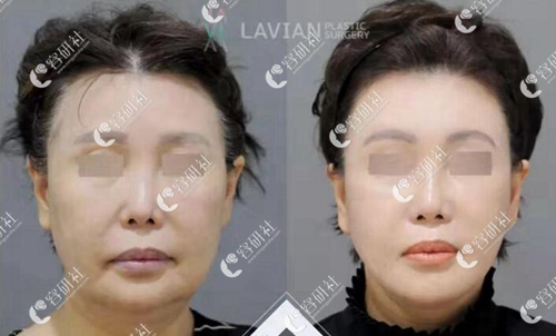 韩国拉菲安整形医院拉皮手术真人案例