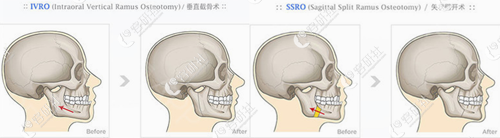 韩国丽珍整形医院RIS双鄂手术方式