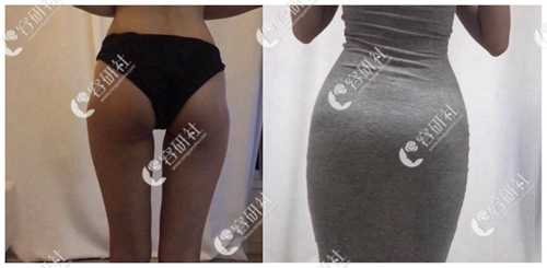 韩国丽妍k整形外科臀部脂肪填充案例