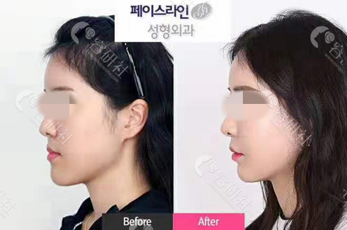 韩国faceline整形外科女生地包天矫正案例