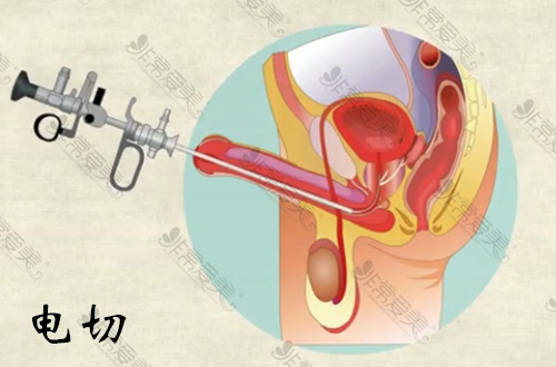 韩国前列腺增生怎么治疗？电切和激光哪个好？