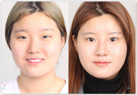 韩国k整形外科眼部综合对比