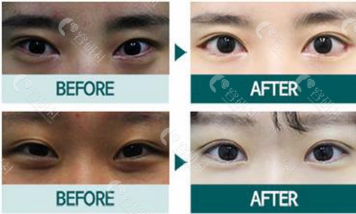 韩国伊美芝整形外科医院眼角修复案例