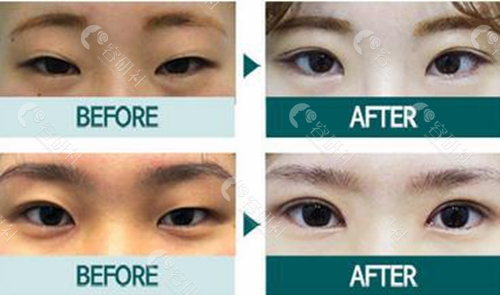 韩国伊美芝整形外科医院双眼皮修复案例