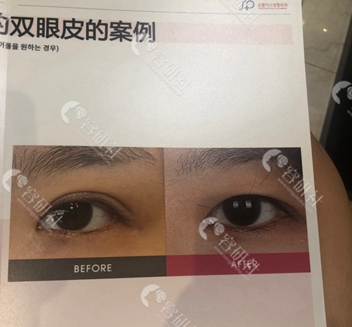 韩国soonplus纯嘉整形医院双眼皮修复案例