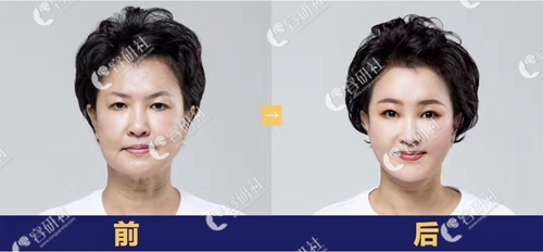韩国卓佑炫整形外科额头提升+额头缩小术后对比图