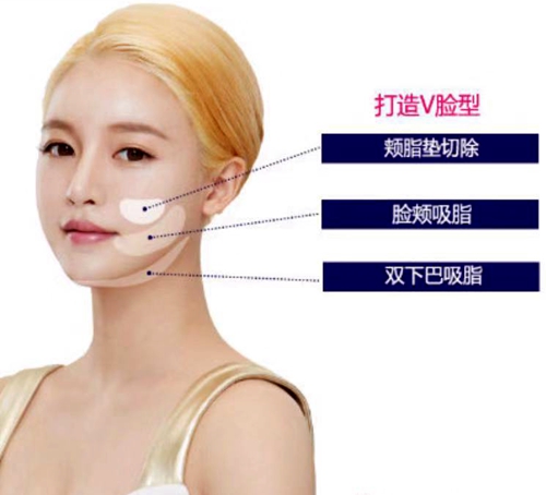 韩国拉菲安整形医院迷你拉皮提升打造V脸施术部位图示