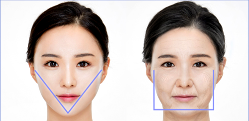 韩国拉菲安整形医院迷你拉皮提升打造V脸效果与术前脸部对比示意图