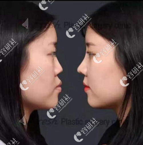 韩国清新整形外科鼻整形案例