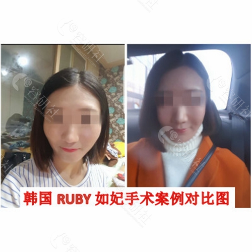 韩国RUBU如妃整形外科医院非固定颧骨内推手术案例
