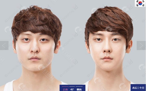 韩国ID整形医院男士轮廓案例