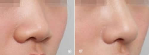 韩国NYPS整形外科隆鼻手术案例对比图