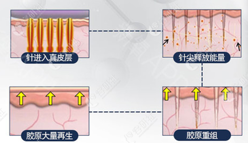 韩国史丹利皮肤整形医院黄金微针手术过程