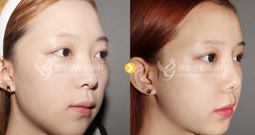 韩国格瑞丝整形外科面部填充案例对比图