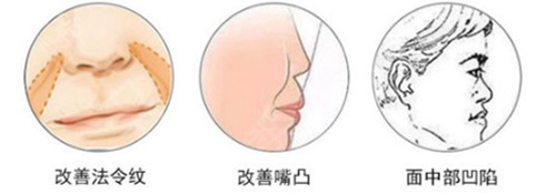 鼻基底手术可以改善的问题