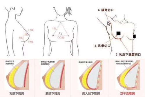 假体隆胸手术中假体的植入层次