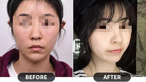 韩国妩阿整形外科皮肤科黄金微针案例