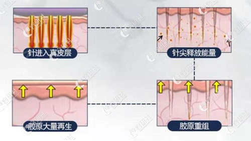 韩国史丹利皮肤整形医院黄金微针手术过程示意图