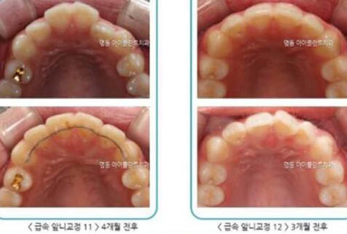 韩国iplant牙科医院牙齿矫正案例图