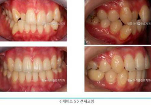 韩国iplant牙科医院牙齿畸形矫正