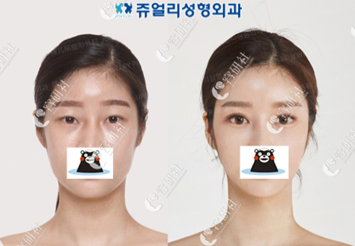 韩国珠儿丽整形外科辛容元院长眼睛手术案例