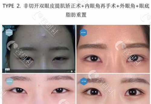 韩国soonplus整形外科双眼皮修复前后效果对比