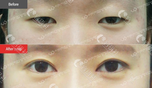 韩国伊美芝整形外科双眼皮手术案例