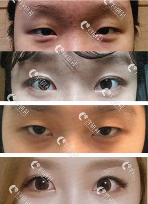 韩国珠儿丽整形外科辛容元初眼手术案例