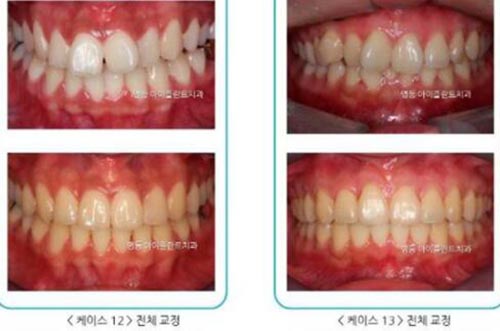 韩国iplant牙科医院牙齿矫正案例