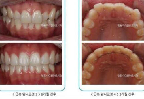 韩国iplant牙科医院牙齿矫正前后对比
