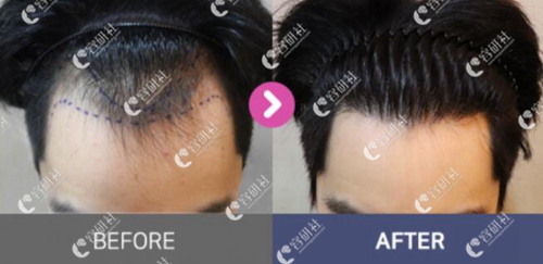 韩国moplus毛发移植医院非切开法毛发移植案例