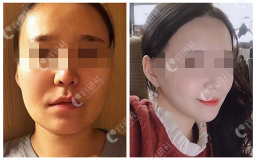 韩国明星线整形外科面吸术前术后对比