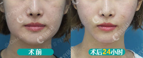 韩国迪美丽整形外科面吸术前术后对比