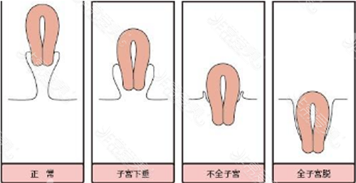 脱垂子宫与正常子宫对比图