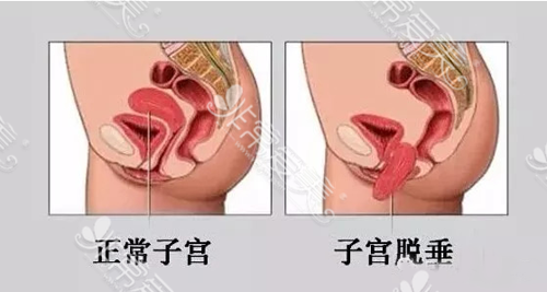 正常子宫与脱垂子宫示意图