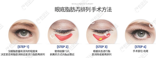韩国宝士丽整形医院眼底脂肪重组手术方法
