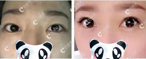 韩国宝士丽整形医院眼底脂肪重组手术案例