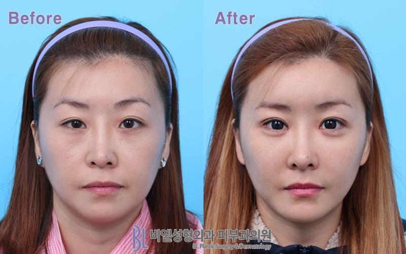 韩国BL整形外科眼部整形案例