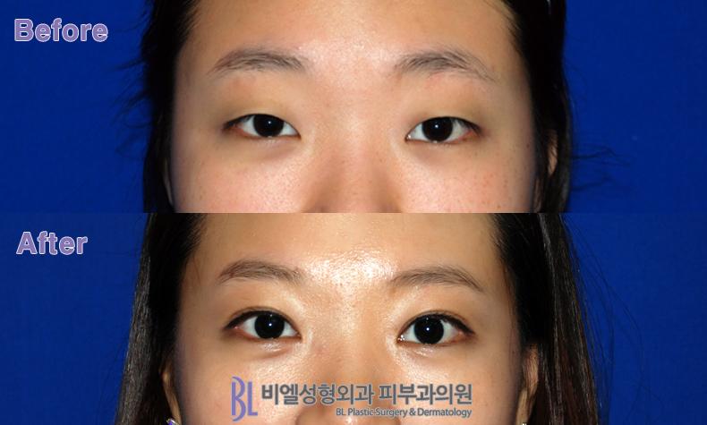 韩国BL医院眼部整形案例对比