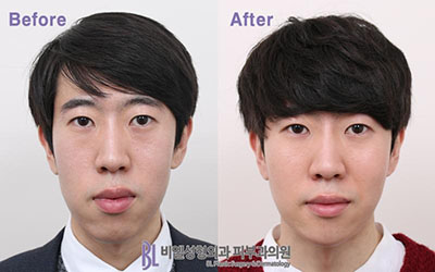 韩国BL整形外科双鄂轮廓手术案例