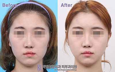 韩国BL整形外科轮廓整形前后对比照片