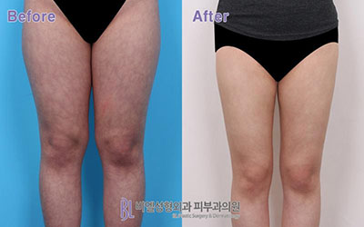 韩国BL整形外科大腿吸脂日记图