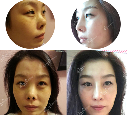 韩国4月31日整形外科鼻修复手术