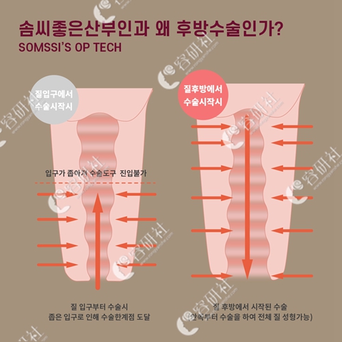 韩国好手艺私密整形医院后方膣圆盖术和普通缩阴术的区别