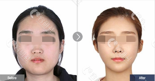 韩国菲斯莱茵整形外科下颌角缩小案例