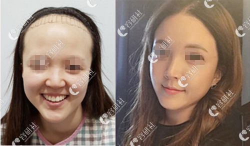 韩国毛杰琳毛发移植医院额头缩小+发际线种植案例
