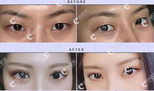 韩国秀美颜整形外科双眼皮案例